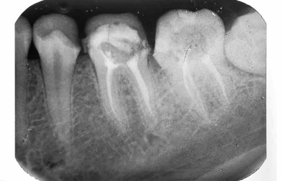 Пломбировка корневых каналов. Рентген пульпита зуба 4.7. Апикальный периодонтит 36 зуба рентген. Периодонтит депульпированного зуба.
