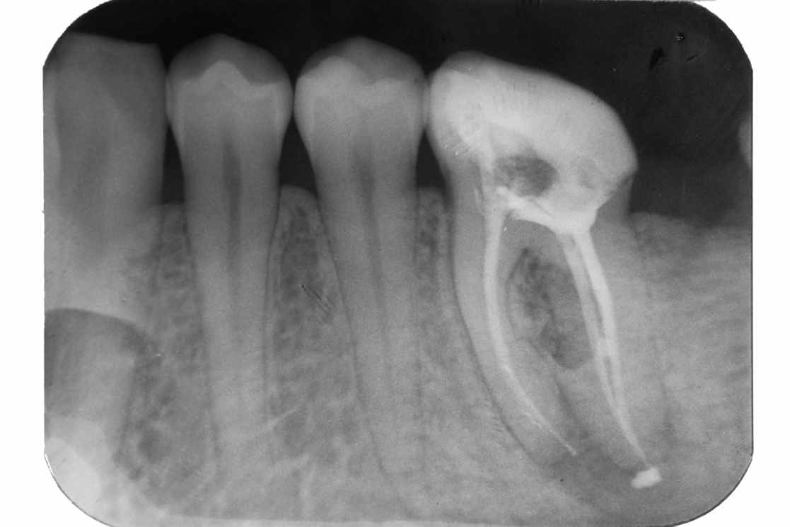 Зуб с удаленным нервом